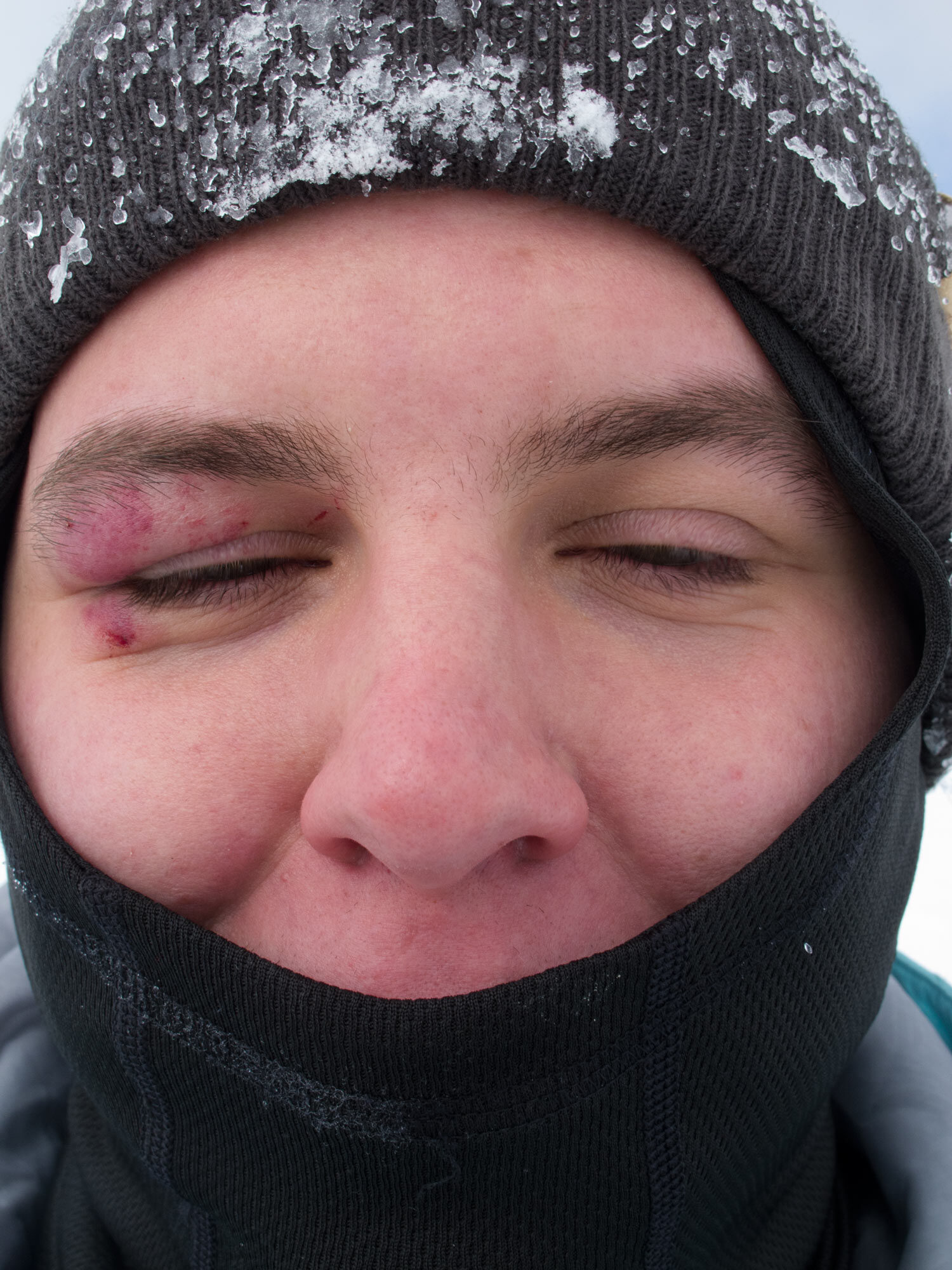 Brian's bunged up bud!